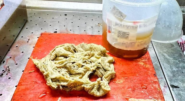 �zel hastanedeki do�umda skandal! Annenin v�cudunda unuttular, 2 y�l sonra fark edildi