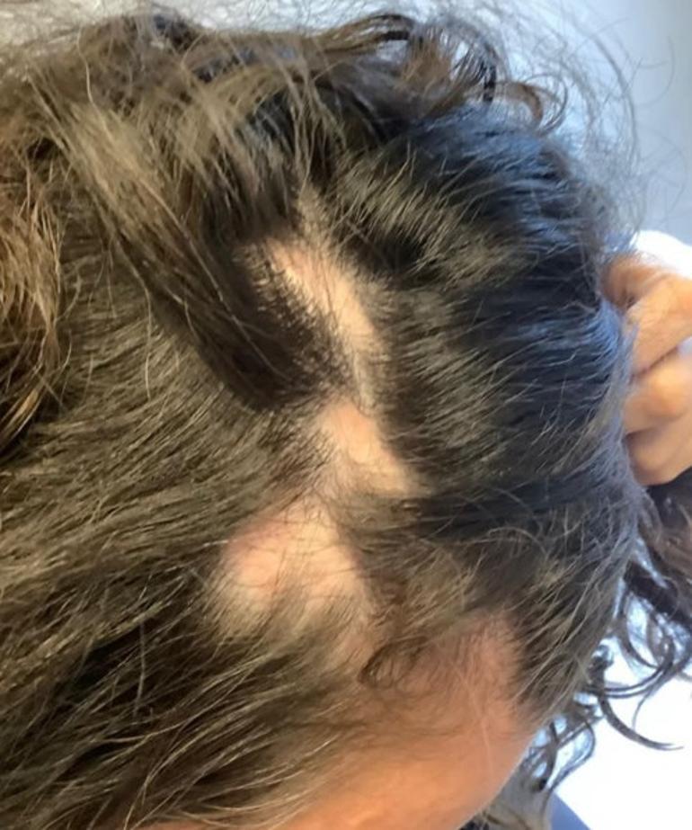 Saldırıya uğrayan Yasemin Sadıkoğlu olaylı geceyi anlattı: Saçımı yolanı kaçırdılar