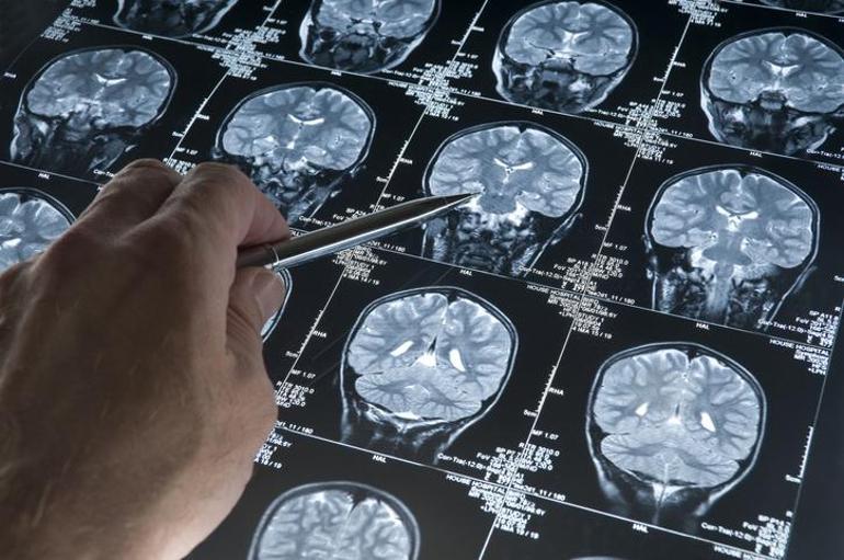 Alzheimer’da yeni tanı yöntemi tartışma yarattı… Milyonlarca sağlıklı insana teşhis konabilir