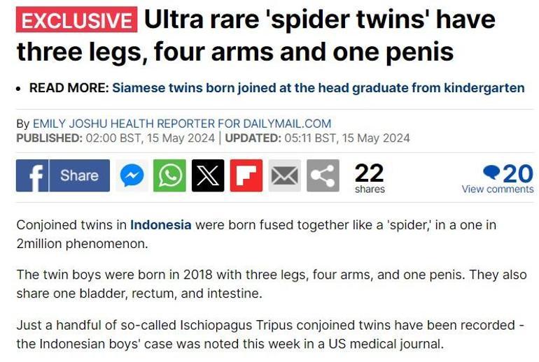 Spider twins, seen once in 2 million, are on the world's agenda... They were born with 3 legs and 4 arms, but could not sit for 3 years...