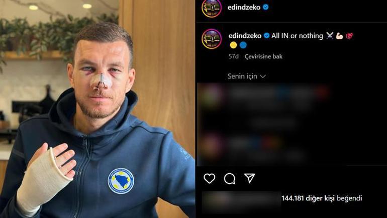Burnu kırılmıştı Edin Dzeko, son halini paylaştı