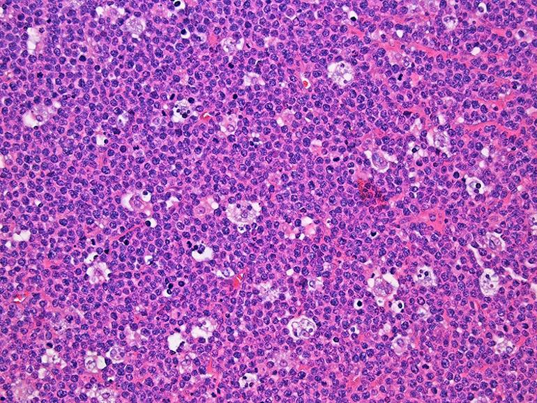 Yumrular, şişlikler, açıklanamayan kanamalar ve morluklar... Fark etmek çok kolay, ihmali ölümcül