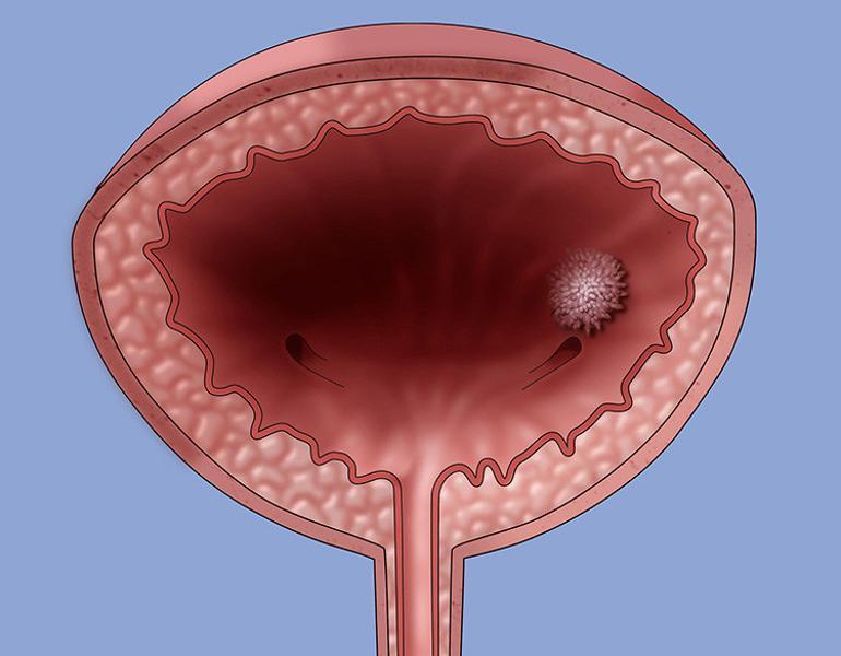 Yumrular, şişlikler, açıklanamayan kanamalar ve morluklar... Fark etmek çok kolay, ihmali ölümcül