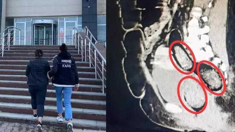İran uyruklu kadının makatından çıktı! Cerrahi operasyon yapıldı