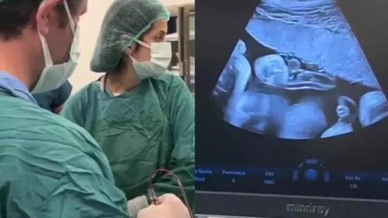 Anne karnındaki 8 aylık bebeğe kan nakli yapıldı