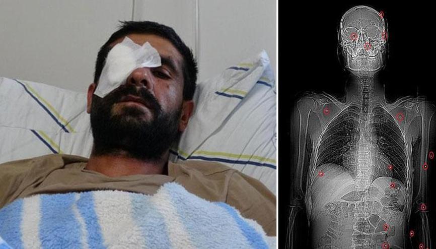 Korkunç olay Hasımları av tüfeğiyle vurdu: Bir gözünü kaybetti, vücudunda 32 saçmayla yaşıyor Korkunç olay Hasımları av tüfeğiyle vurdu: Bir gözünü kaybetti, vücudunda 32 saçmayla yaşıyor