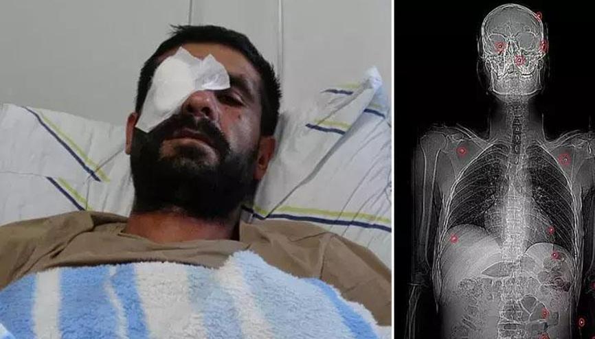 Hasımları av tüfeğiyle vurdu: Bir gözünü kaybetti, vücudunda 32 saçmayla yaşıyor Hasımları av tüfeğiyle vurdu: Bir gözünü kaybetti, vücudunda 32 saçmayla yaşıyor