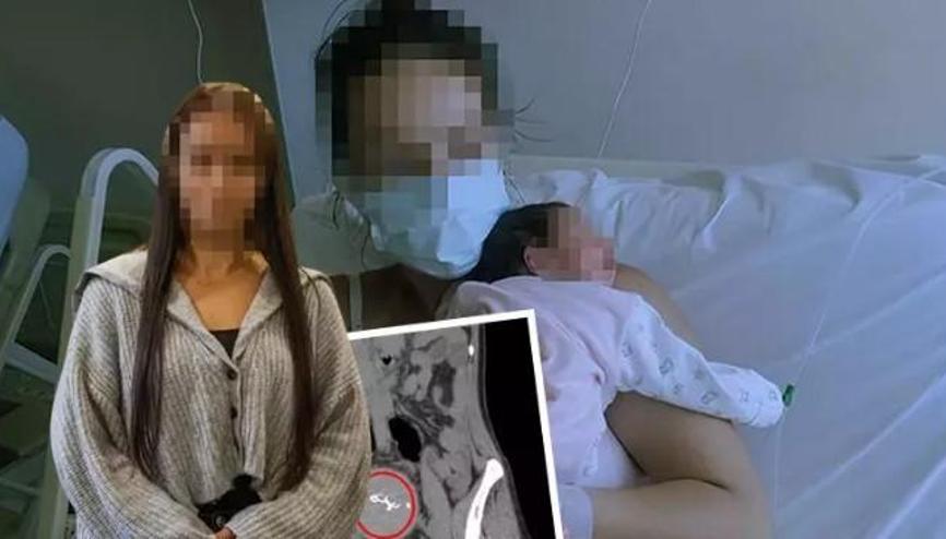 Antalyada doğumda annenin vücudunda unutulan gazlı bez, 2 yıl sonra fark edildi Antalyada doğumda annenin vücudunda unutulan gazlı bez, 2 yıl sonra fark edildi
