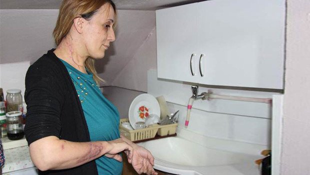 Lavabo açıcı vücudunu yaktı