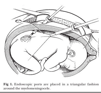 Minicik bedenler doğmadan ameliyat oldu