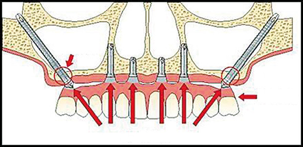 Elmacık kemiğine implant