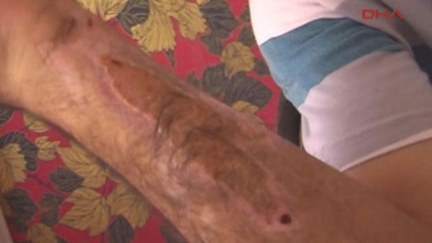 Sigara böreği tavada patladı