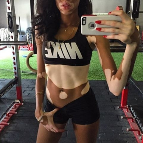 Hastalığını avantaja çevirdi: Winnie Harlow