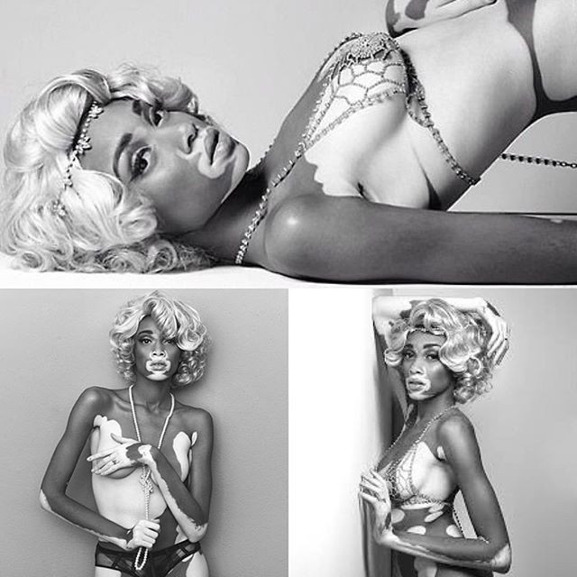 Hastalığını avantaja çevirdi: Winnie Harlow