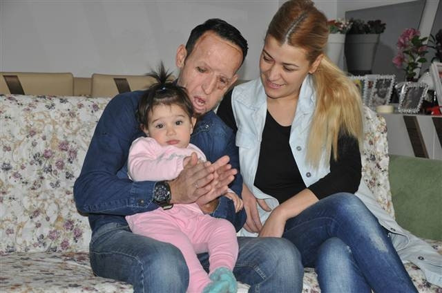 Yüz nakli olan Recep Sert’in son hali