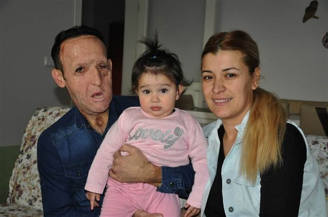 Yüz nakli olan Recep Sert’in son hali