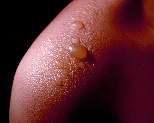 Güneş yanıklarına iyi gelecek 6 doğal yöntem Güneş yanıklarına iyi gelecek 6 doğal yöntem