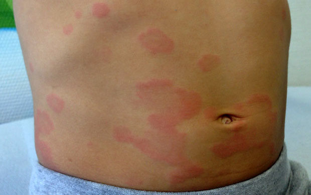 Ürtiker neden olur Belirtileri, çeşitleri, tedavisi