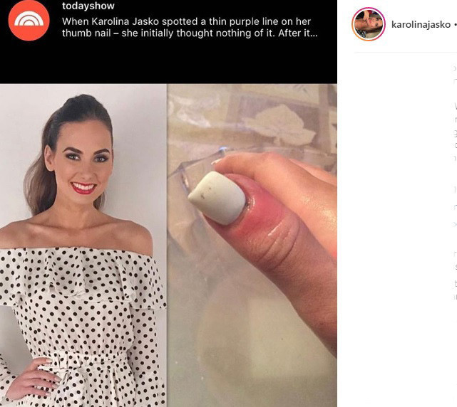 Ünlü model kanser atlattı Şans eseri öğrenmişti Ünlü model kanser atlattı Şans eseri öğrenmişti