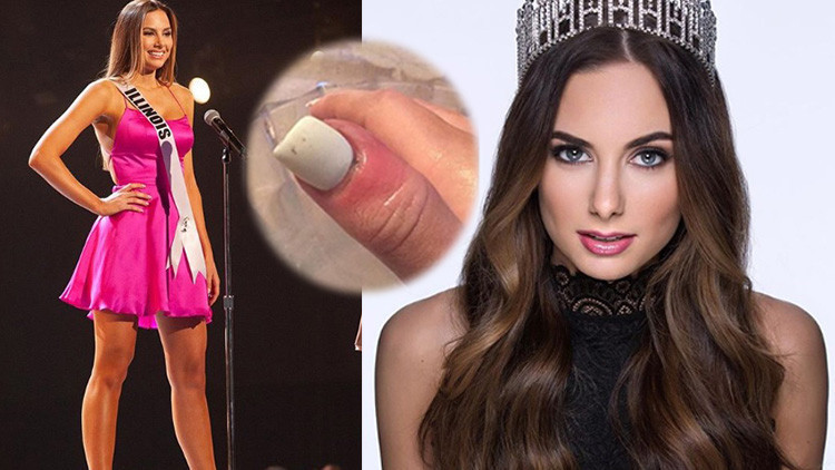 Ünlü model kanser atlattı Şans eseri öğrenmişti Ünlü model kanser atlattı Şans eseri öğrenmişti