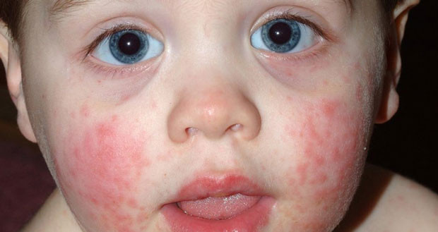 Bebeklerde atopik dermatite karşı etkili öneriler