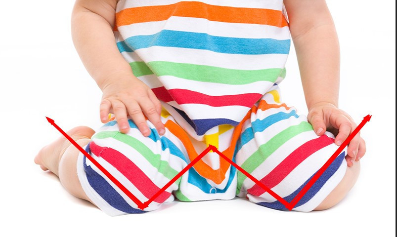 Çocuklarda içe basma nasıl tedavi edilir