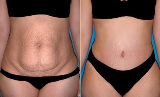 “Mommy makeover” denilen yani doğumdan sonra oluşabilecek vücut deformitelerini düzeltmek