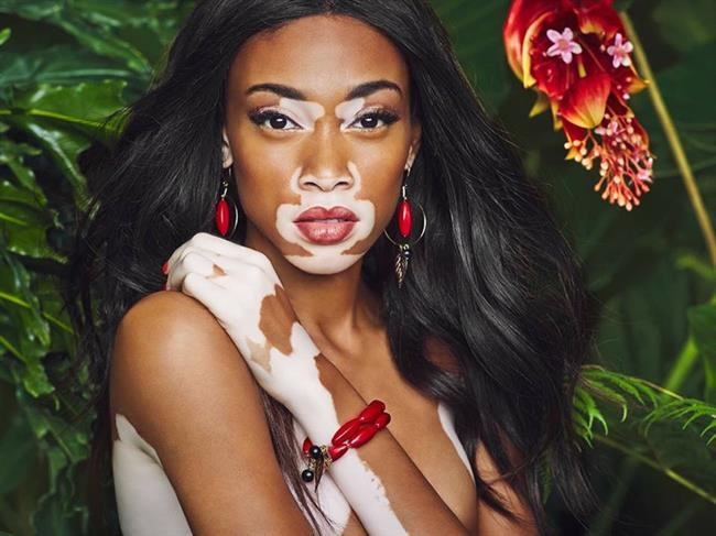 Winnie Harlow Winnie Harlow