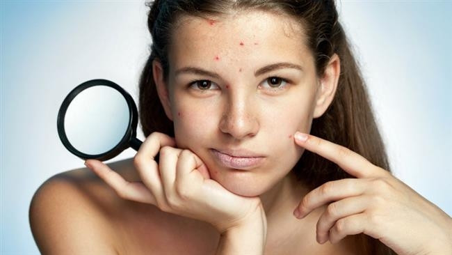 Acıbadem Bahçeşehir Tıp Merkezi Dermatoloji Uzmanı Dr. Mehmet Özeren yüzün yanı sıra omuz, sırt ve göğüs bölgesinde de kendini gösteren aknenin kronik bir tablo olduğundan tedavisinin uzun sürebildiğini söylüyor. Özellikle gençlerin yüzde 90’ında kendini göstermesine rağmen akneye sadece ergenlik değil vitamin takviyelerinden kozmetik ürünlere, sigaradan strese birçok faktörün neden olabildiğini vurgulayan Dr. Mehmet Özeren “Aknenin nedenleri çok çeşitli olduğu için tedavisinde de farklı yaklaşımlar gerektirir. Aknenin bıraktığı iz günümüzde sıkça uygulanan CO2 lazer sayesinde iyice azalsa da bu safhaya gelmeden tedavi edilmesi çok daha önemlidir” diyor.İşte akneye yol açan 10 önemli neden Acıbadem Bahçeşehir Tıp Merkezi Dermatoloji Uzmanı Dr. Mehmet Özeren yüzün yanı sıra omuz, sırt ve göğüs bölgesinde de kendini gösteren aknenin kronik bir tablo olduğundan tedavisinin uzun sürebildiğini söylüyor. Özellikle gençlerin yüzde 90’ında kendini göstermesine rağmen akneye sadece ergenlik değil vitamin takviyelerinden kozmetik ürünlere, sigaradan strese birçok faktörün neden olabildiğini vurgulayan Dr. Mehmet Özeren “Aknenin nedenleri çok çeşitli olduğu için tedavisinde de farklı yaklaşımlar gerektirir. Aknenin bıraktığı iz günümüzde sıkça uygulanan CO2 lazer sayesinde iyice azalsa da bu safhaya gelmeden tedavi edilmesi çok daha önemlidir” diyor.İşte akneye yol açan 10 önemli neden