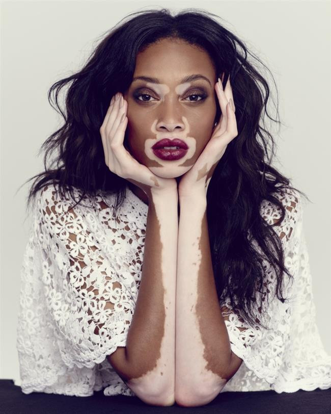 Winnie Harlow Winnie Harlow