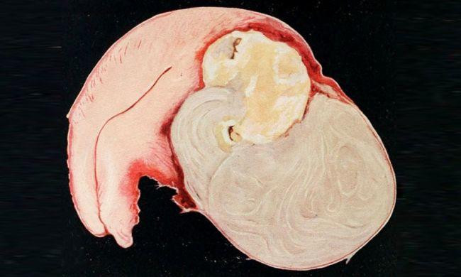 Rahimde miyom neden oluşur Miyom nasıl tedavi edilir