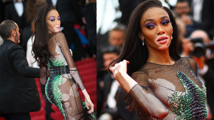 Güzellik Algısını Baştan Yaratan Kadın: Winnie Harlow Güzellik Algısını Baştan Yaratan Kadın: Winnie Harlow