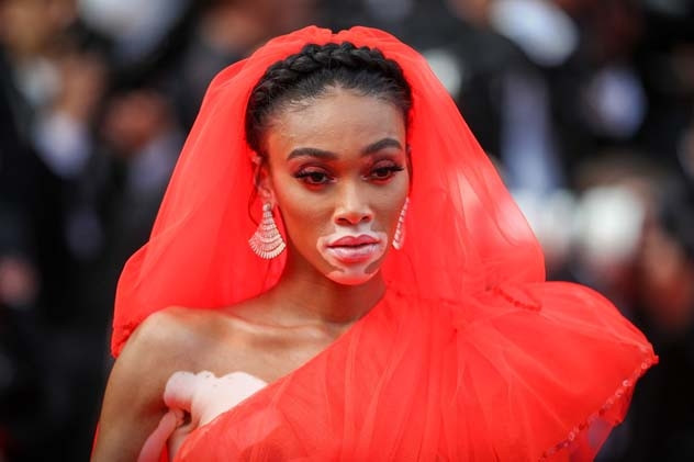 Güzellik Algısını Baştan Yaratan Kadın: Winnie Harlow Güzellik Algısını Baştan Yaratan Kadın: Winnie Harlow