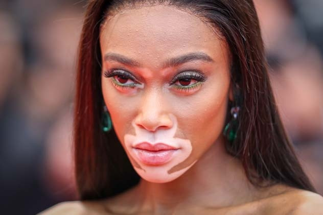 Güzellik Algısını Baştan Yaratan Kadın: Winnie Harlow Güzellik Algısını Baştan Yaratan Kadın: Winnie Harlow