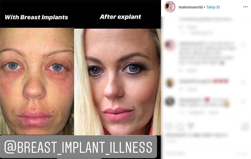 Silikonlu göğüslerim yüzünden öleceğim sandım