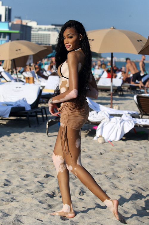 Winnie Harlow: Küçükken alay ederlerdi, şimdi milyon dolarlık servetin sahibi Winnie Harlow: Küçükken alay ederlerdi, şimdi milyon dolarlık servetin sahibi