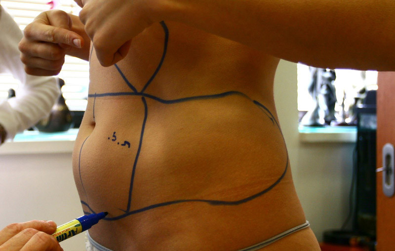 Karın germe ameliyatı nasıl yapılır