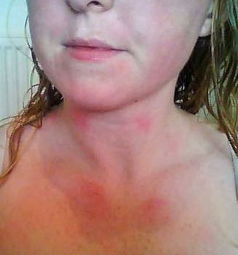 Su alerjisi yüzünden ağlayamıyor