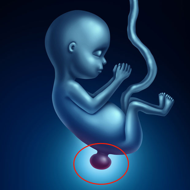 Spina bifida nedir Spina bifida nedenleri, tedavisi