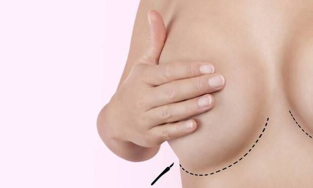 Meme küçültme ameliyatında hangi teknikler uygulanır