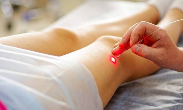 Ameliyatsız varis tedavisi mümkün