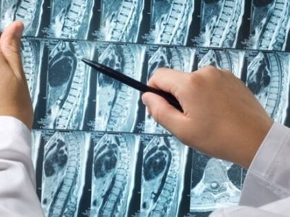 Ergenlikte 10 kişiden 1’inde skolyoz görülüyor