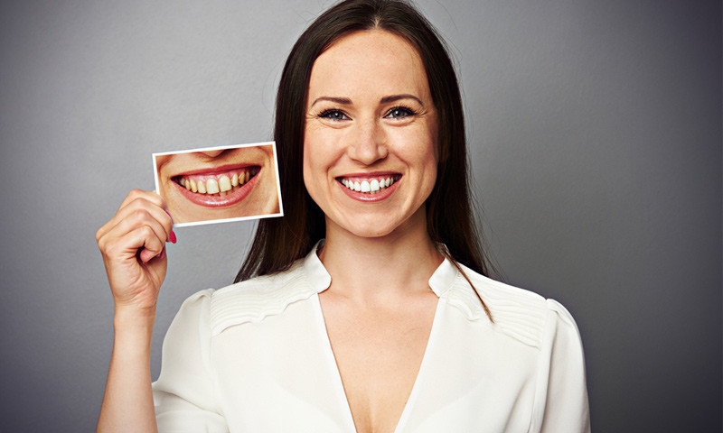 Dijital gülüş tasarımı nedir Nasıl yapılır