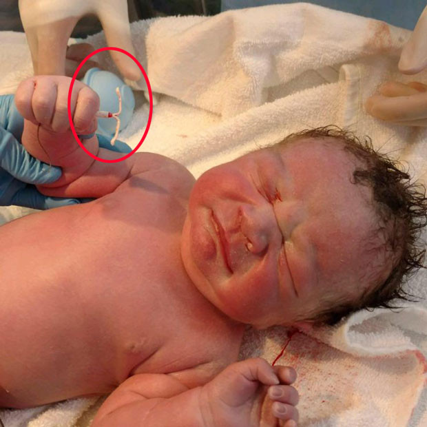 ABD’li bebek, elinde spiral ipi ile doğdu