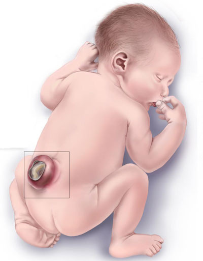 Spina bifida, anne karnında teşhis edilebiliyor