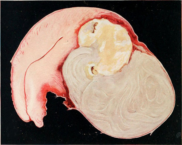 Şişkinlik sandığınız miyom olabilir