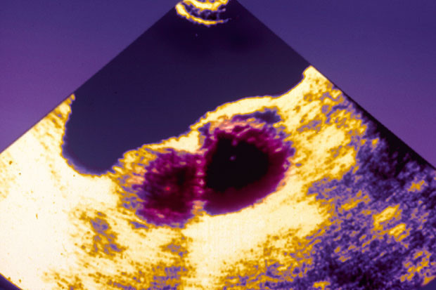 Polikistik Over Sendromu nedir PKOS hastaları hamile kalabilir mi