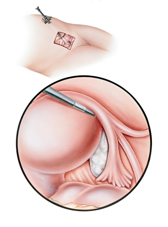 Laparoskopi nedir Laparoskopi nasıl yapılır