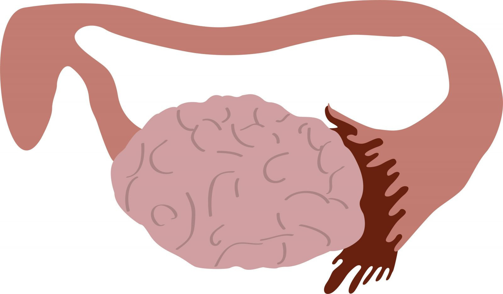 Polikistik over sendromu uzun dönemde sağlık sorunlarına sebep olur mu