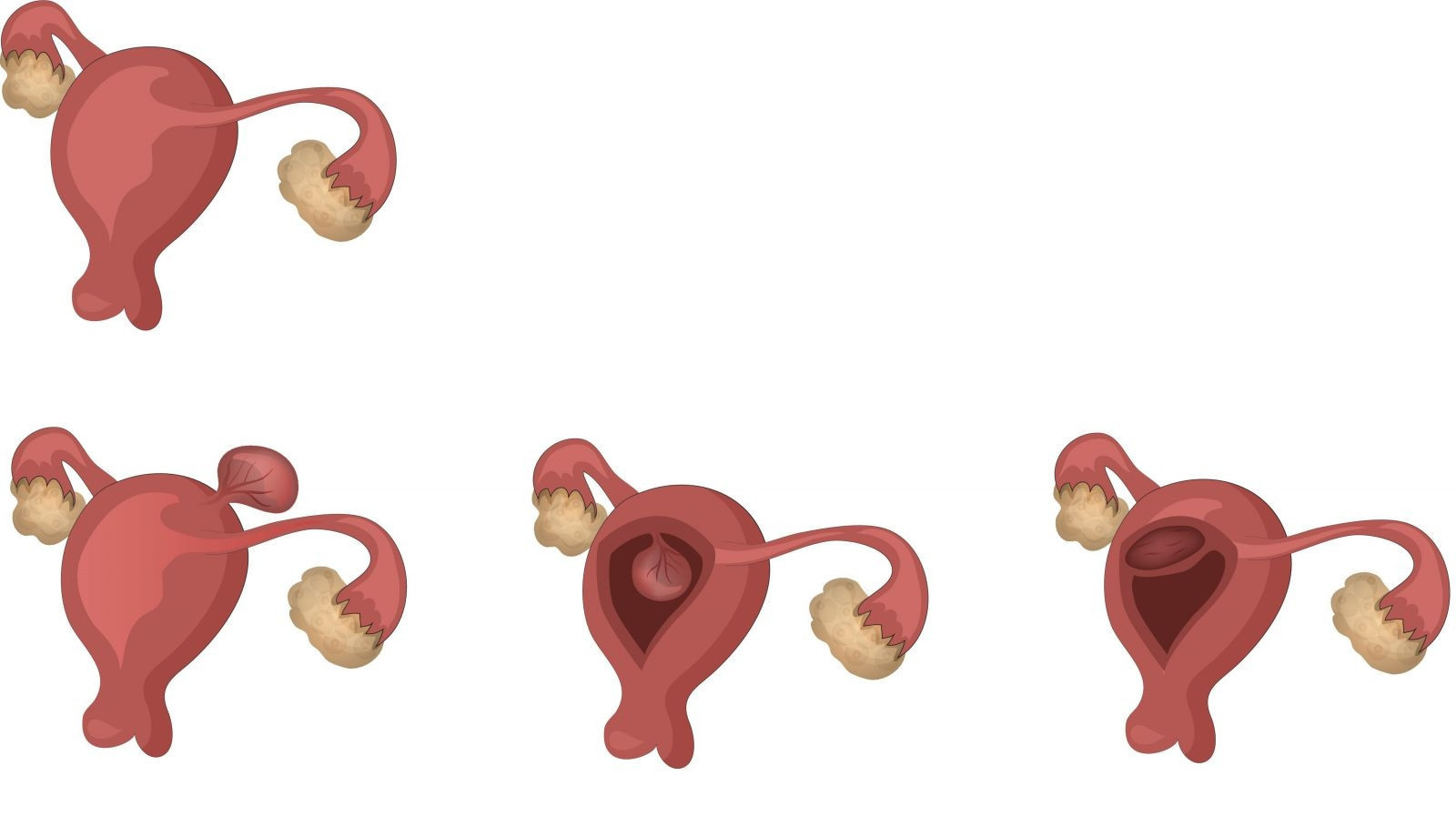 Miyom (myoma uteri) nedir Miyomlar neden gelişir